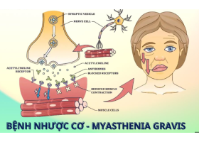nhuoc-co-5939.png